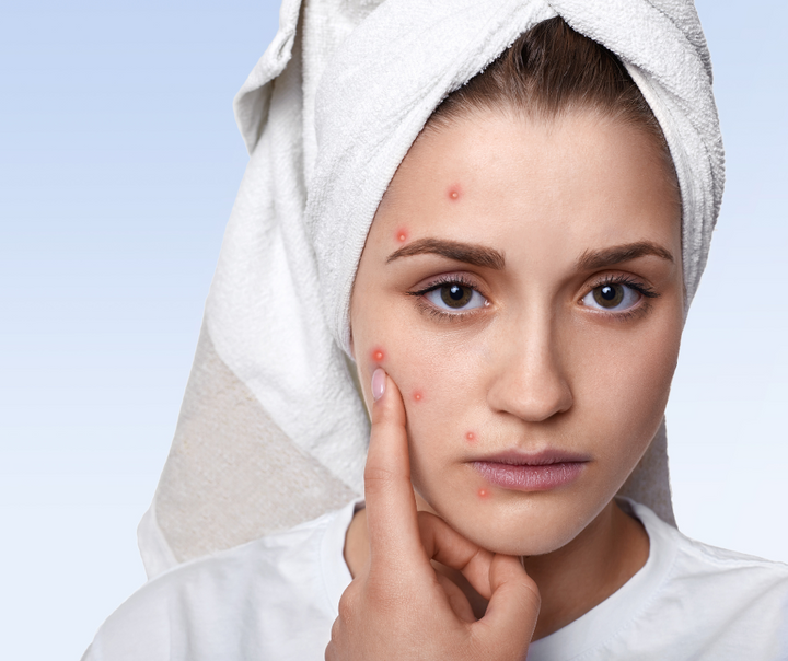 Are Your Makeup Products Causing Acne?
