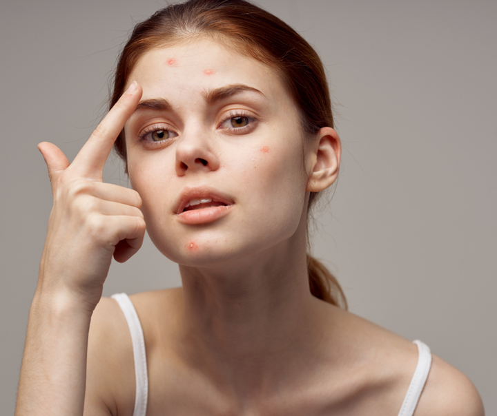 4 Toxin-Free Ways To Manage Acne